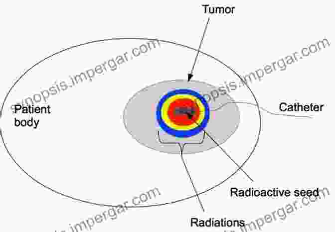 Diagram Illustrating The Principles Of Brachytherapy The Physics Of Modern Brachytherapy For Oncology (Series In Medical Physics And Biomedical Engineering)