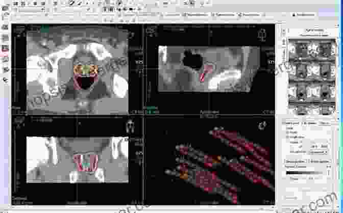 Image Showing Advanced Brachytherapy Treatment Planning System The Physics Of Modern Brachytherapy For Oncology (Series In Medical Physics And Biomedical Engineering)